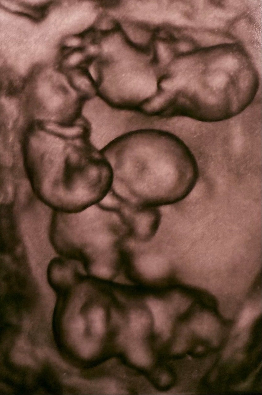 Однояйцевые четверняшки впервые родились в России Однояйцевые четверняшки впервые родились в России